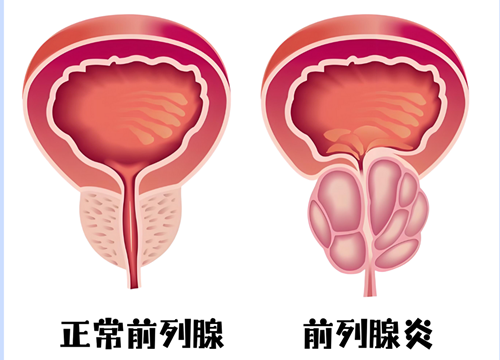 前列腺炎反复发作？医生总结5个最易忽略的诱因